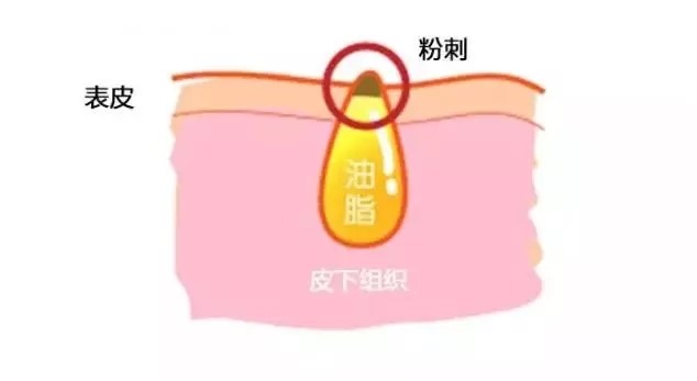 海口青春痘